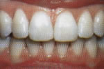 Clear Braces Southgate