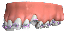 Dental Braces