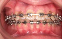 Fixed Braces Southgate