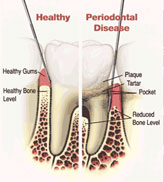 Periodontal Treatment